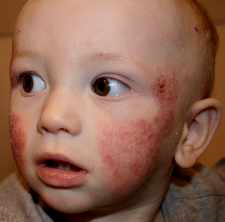 Can atopic dermatitis affect the face? - MedicineNet