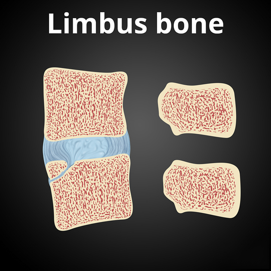 Limbus vertebra vs Fracture : 네이버 블로그