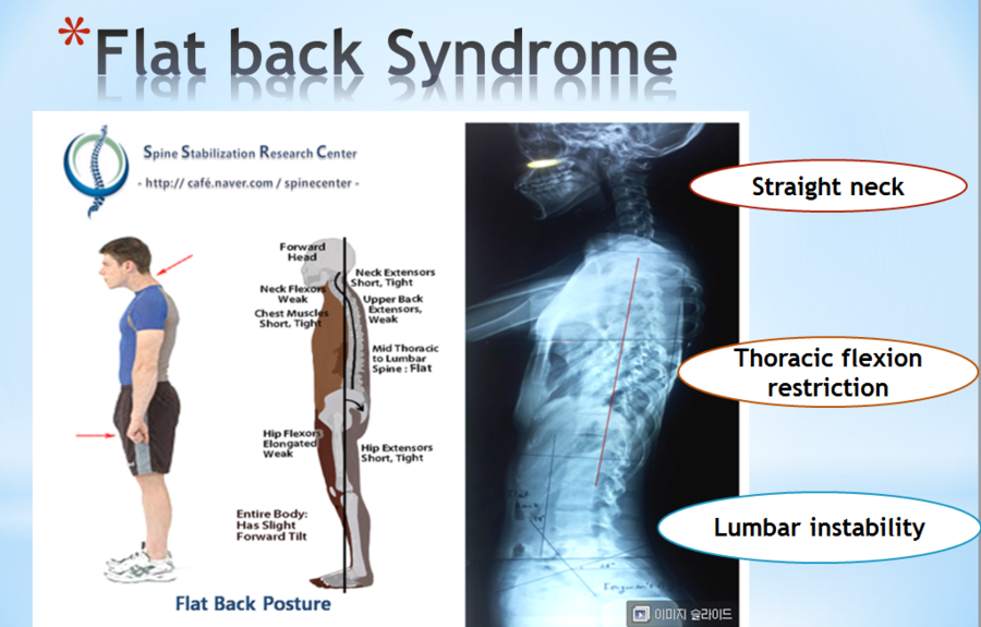(송파동PT) 편평등 및 움직임 기능부전을 가진 고객 요통 회복 사례 네이버 블로그