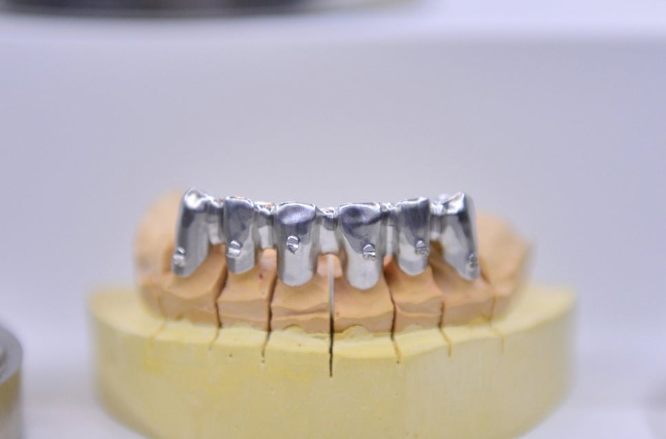 메탈크라운 은니 vs 골드크라운 금니 비교 : 네이버 블로그