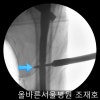 orif intertrochanteric fracture